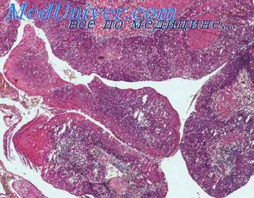 высыпания капози