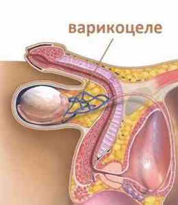 Варикоцеле