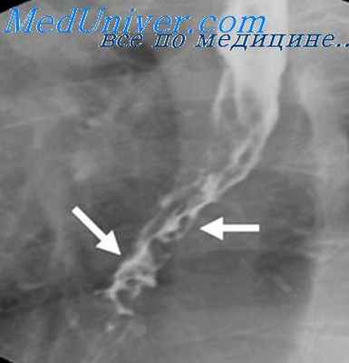 поражение вен пищевода