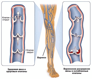 Нормальные вены и расширенные вены