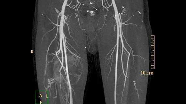 Флебография