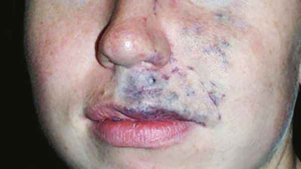 Венозная мальформация