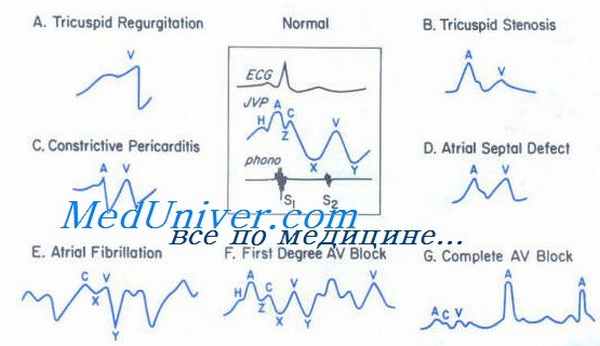 венозная гипертензия