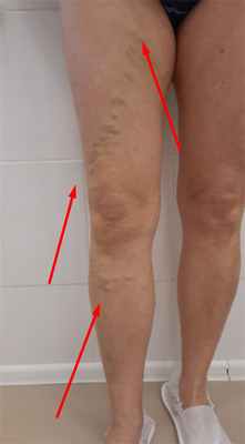 Варикоз в системе большой подкожной вены