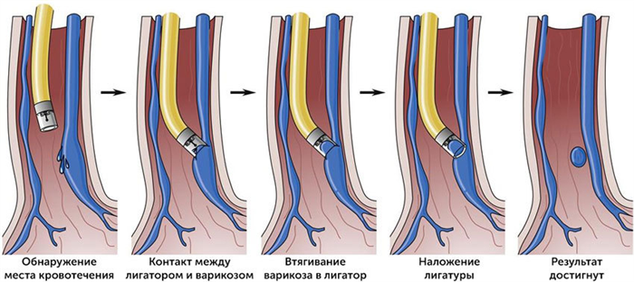Лигирование вен пищевода