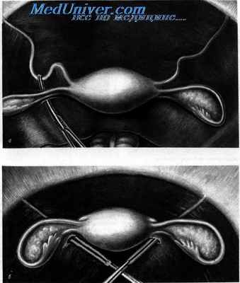 Укорочение круглых маточных связок по Бальди—Вебстеру