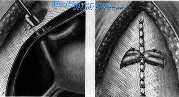 Вентросуспензия матки