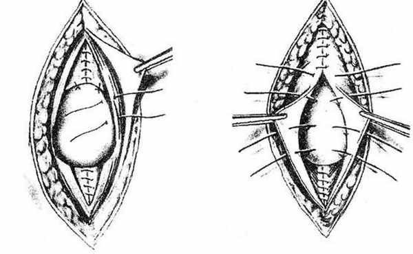 Схема ентрофиксации матки