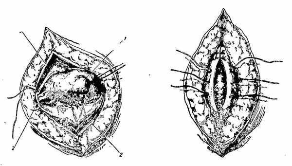 Вентросуспензия синтетическим имплантом