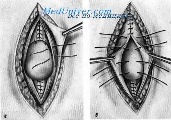 Вентрофиксация матки
