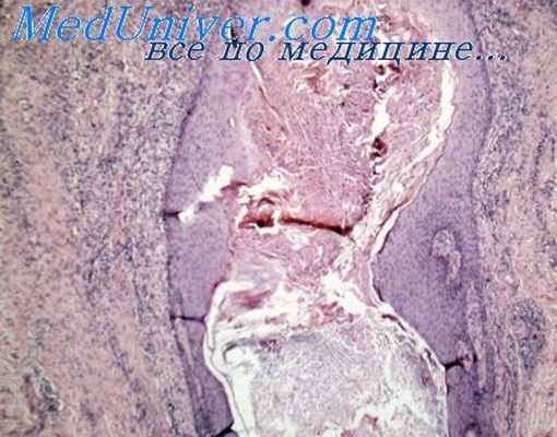 акрокератоз гопфа