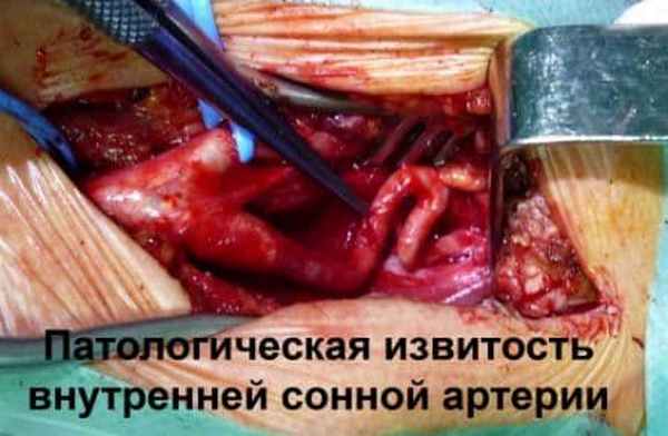 Патологическая деформация брахиоцефальных 3.jpg