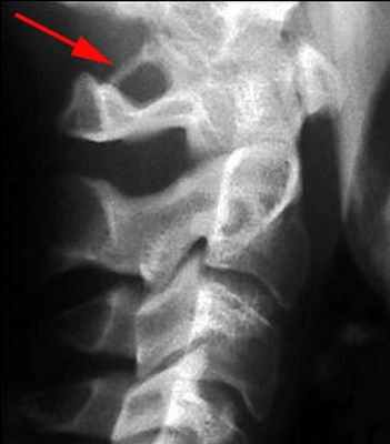 Аномалия Киммерли