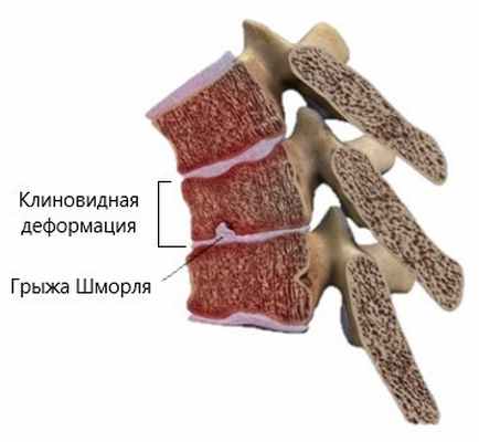 Болезнь Шейермана- Мау (юношеский кифоз).jpg