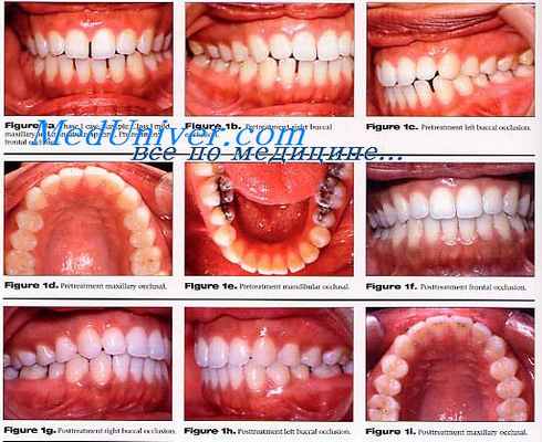 вестибулярная дуга энгля
