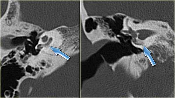 КТ-картина оссификации (обызвествления) лабиринта