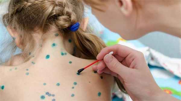 Ветрянка (ветряная оспа)