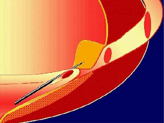 ЛЕЧЕНИЕ ПУЗЫРНО-МОЧЕТОЧНИКОВОГО РЕФЛЮКСА У ДЕТЕЙ В ДОКБ