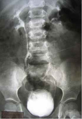 ЛЕЧЕНИЕ ПУЗЫРНО-МОЧЕТОЧНИКОВОГО РЕФЛЮКСА У ДЕТЕЙ В ДОКБ