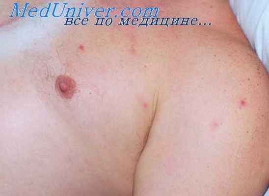 везикулезный риккетсиоз