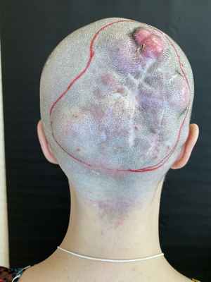 «Врачи сказали – мне снимут полностью весь скальп». История нашей 30-летней пациентки из Саратова с саркомой мягких тканей головы. 