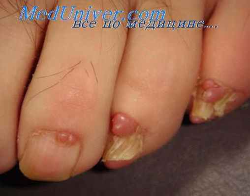 гистиоцитома