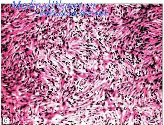 Выбухающая дерматофибросаркома