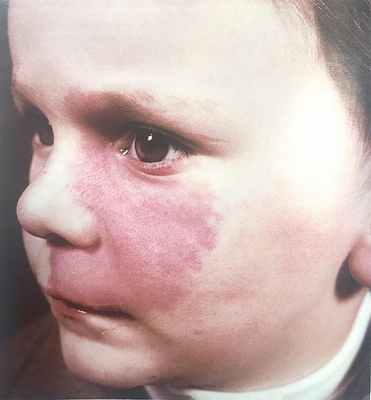 Винные пятна (пламенеющий невус) у ребенка