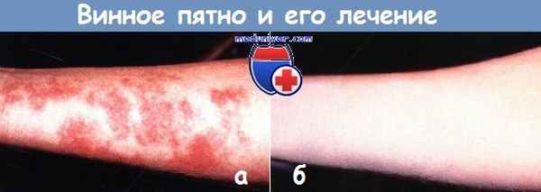 Винное пятно и его лечение