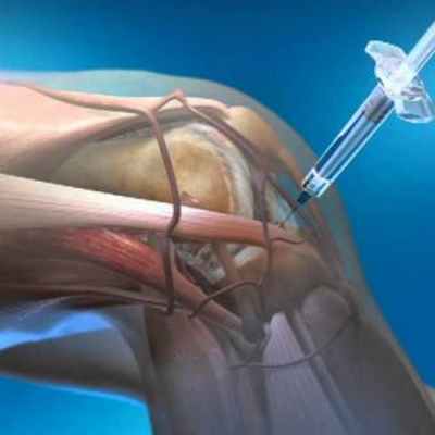 Прокол суставов