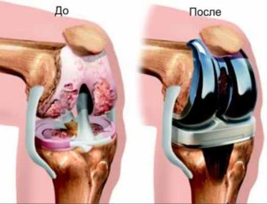 Замена коленного сустава в Израиле