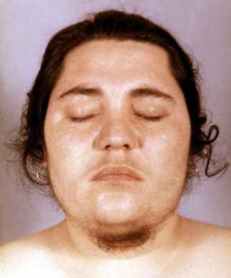 Больная с андростеромой; отчетливо виден рост волос на лице по мужскому типу (гирсутизм)