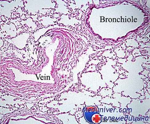 лимфаденопатия