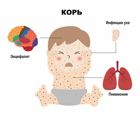 Коревой энцефалит.jpg