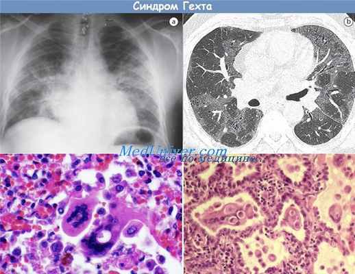синдром Гехта - вирусная пневмония