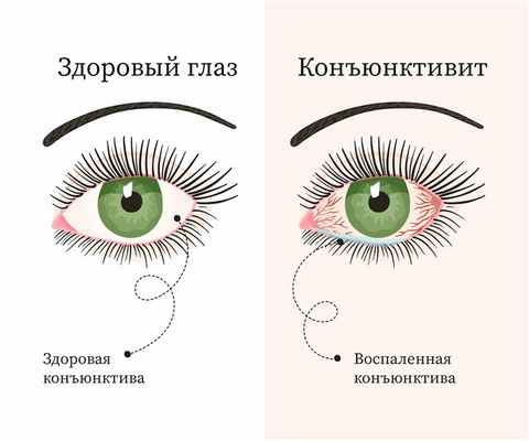 Вирусный конъюнктивит: причины, симптомы и лечение
