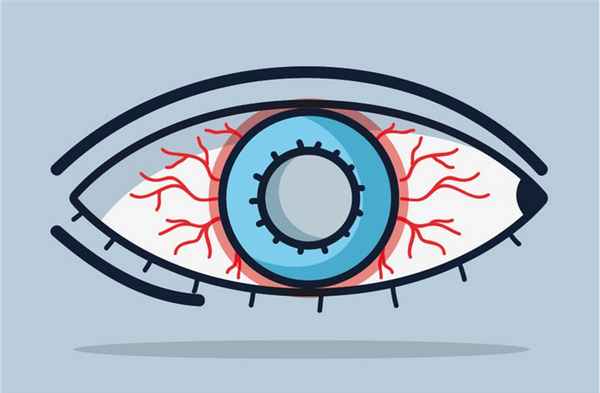 Вирусный конъюнктивит: причины, симптомы и лечение