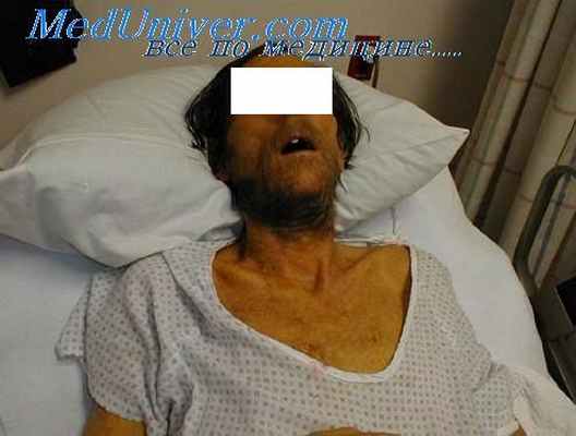 сепсис синдром