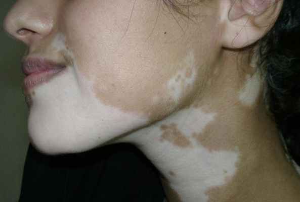vitiligo_neck.jpg