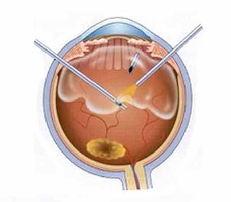 микроинвазивная витрэктомия.jpg