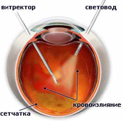 vitrectomy.jpg