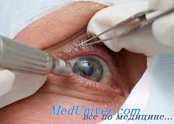 витрэктомия при эндофтальмите