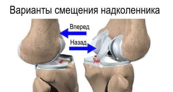 Виды вывиха надколенника