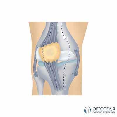 вывих надколенника схема_03.jpg