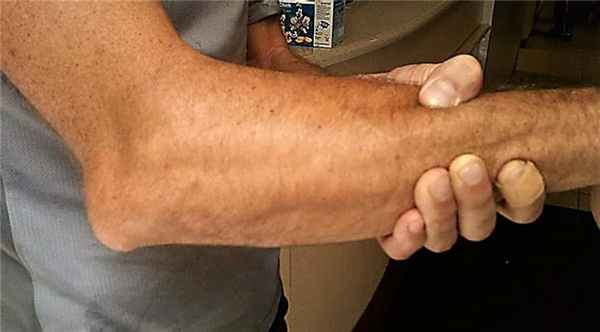 деформация локтевого сустава