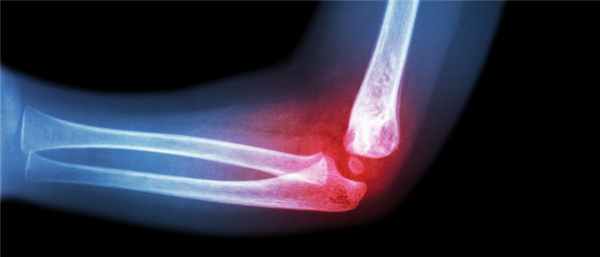 вывих локтевого сустава