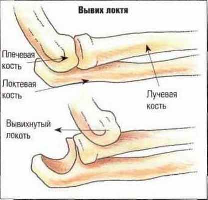 Вывих локтевого сустава, методы лечения и реабилитации
