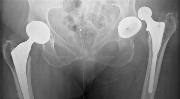 вывих эндопротеза