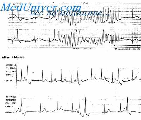 желудочковая экстрасистола