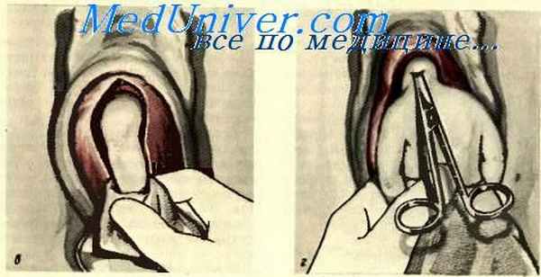 Влагалищное кесарево сечение.